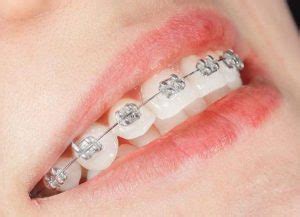 Ortodoncia con Brackets metálicos – B. Palmas